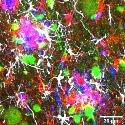 New advances in the study of Alzheimer's disease reported